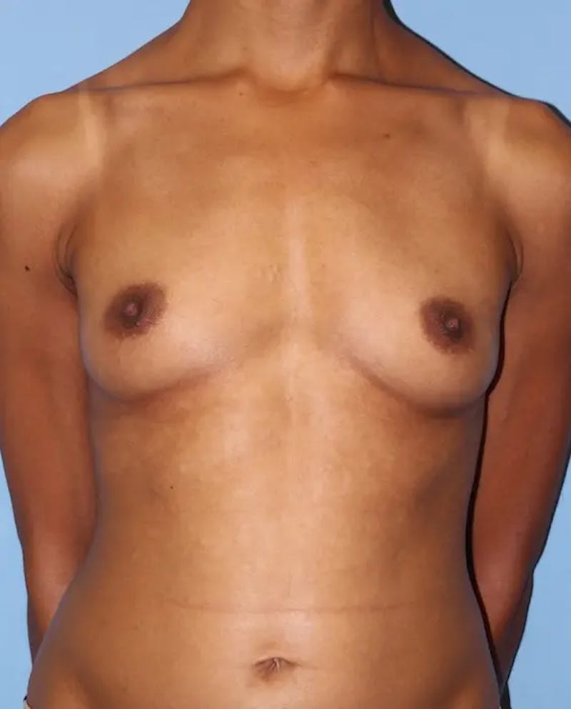 Breast Augmentation Before & After Gallery - Patient 420721 - Image 1