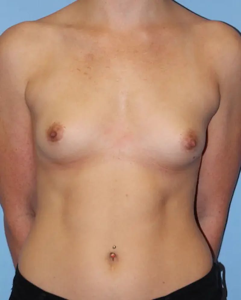 Breast Augmentation Before & After Gallery - Patient 233652 - Image 1
