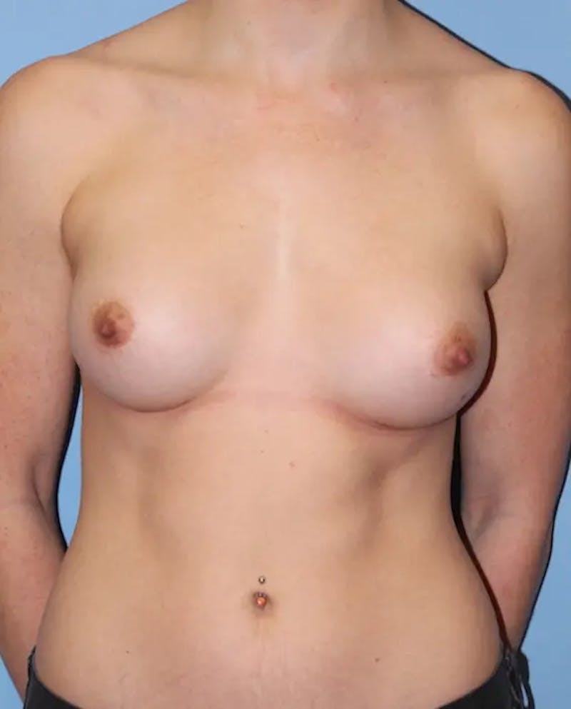 Breast Augmentation Before & After Gallery - Patient 233652 - Image 2