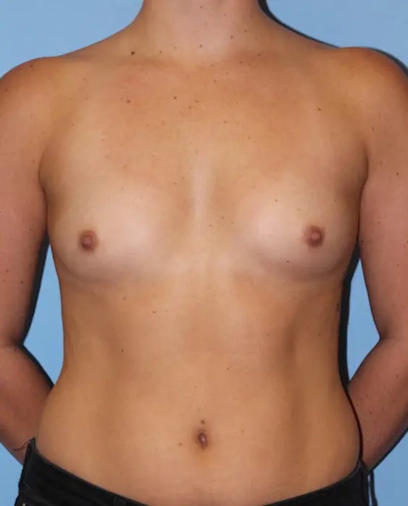 Breast Augmentation Before & After Gallery - Patient 239672 - Image 1