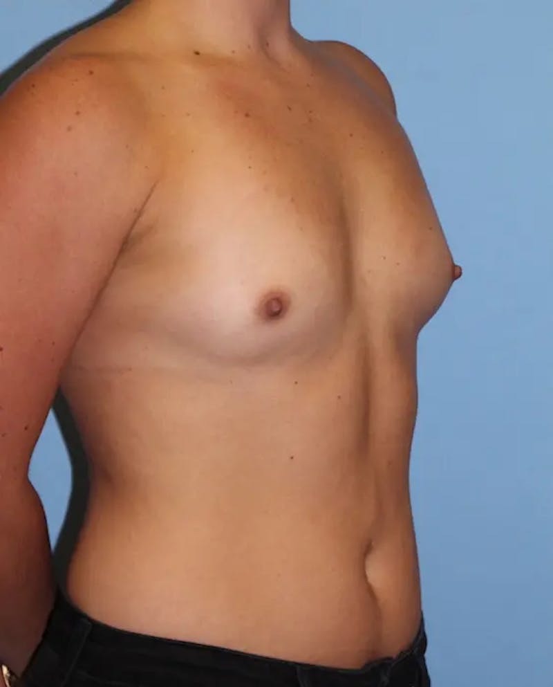 Breast Augmentation Before & After Gallery - Patient 239672 - Image 3