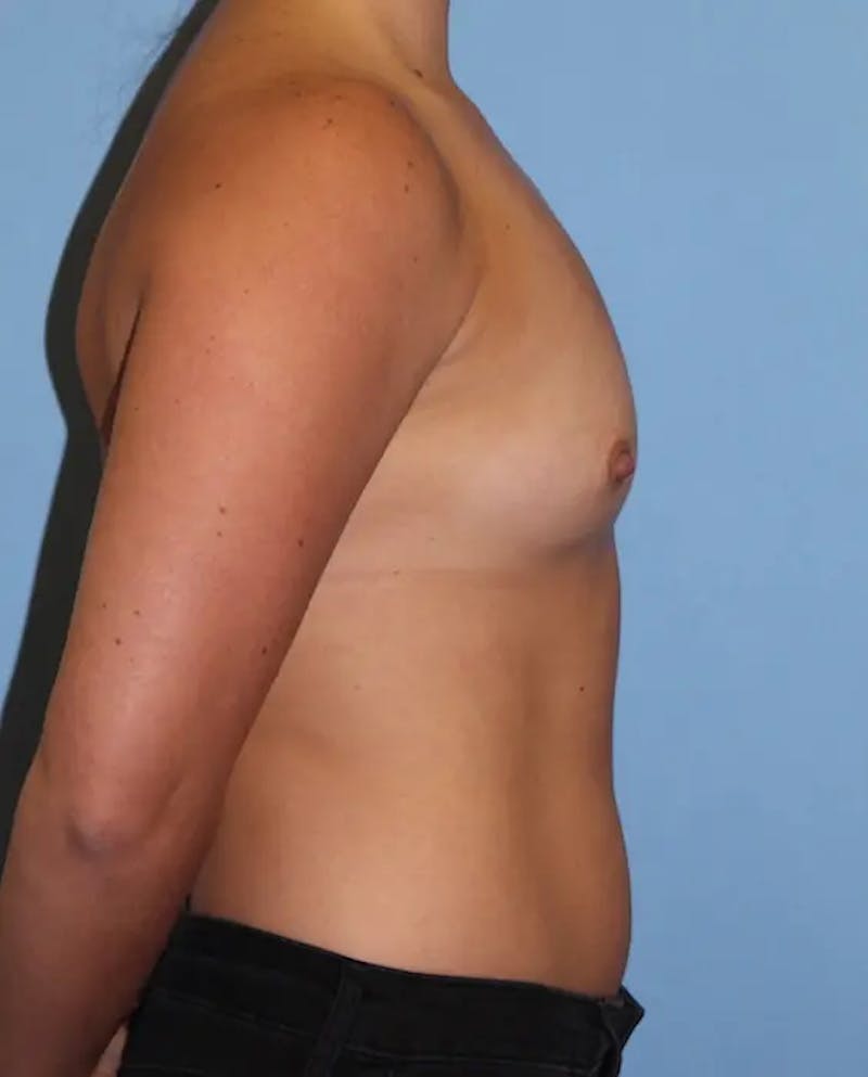 Breast Augmentation Before & After Gallery - Patient 239672 - Image 5