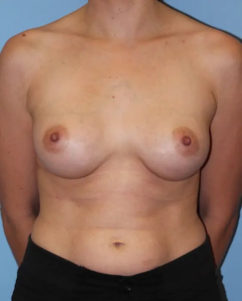Breast Augmentation Before & After Gallery - Patient 417186 - Image 2