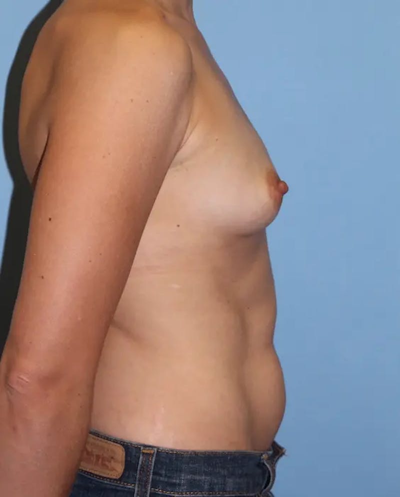 Breast Augmentation Before & After Gallery - Patient 417186 - Image 5