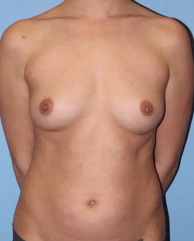 Breast Augmentation Before & After Gallery - Patient 289518 - Image 1