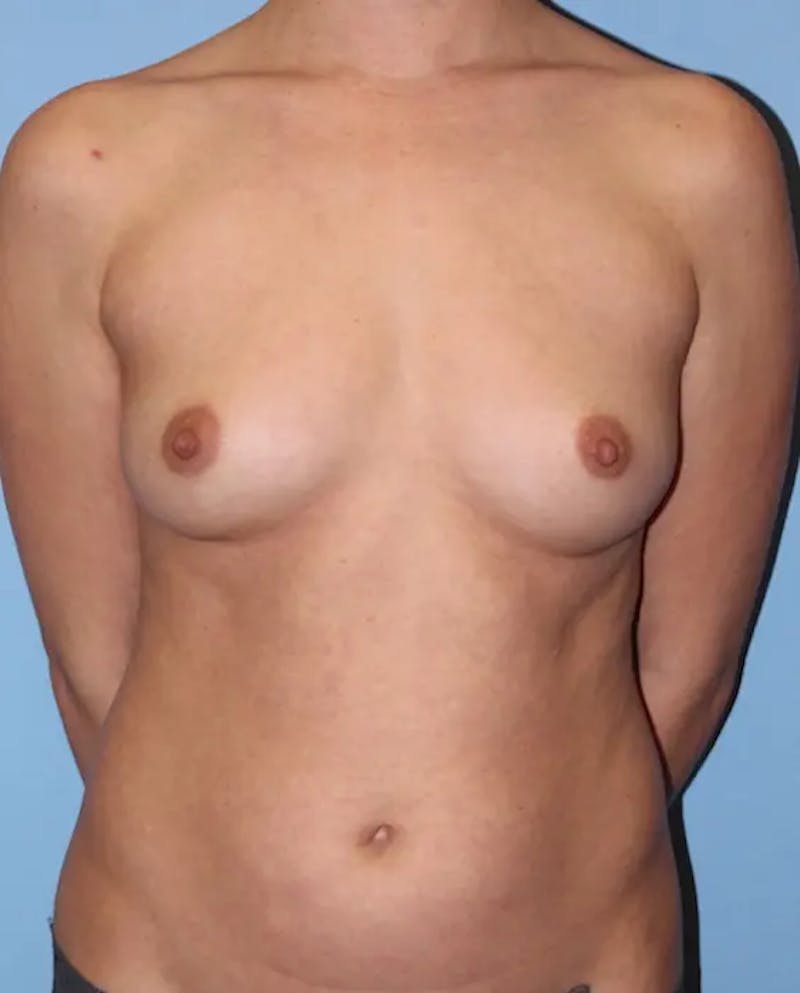 Breast Augmentation Before & After Gallery - Patient 289518 - Image 1
