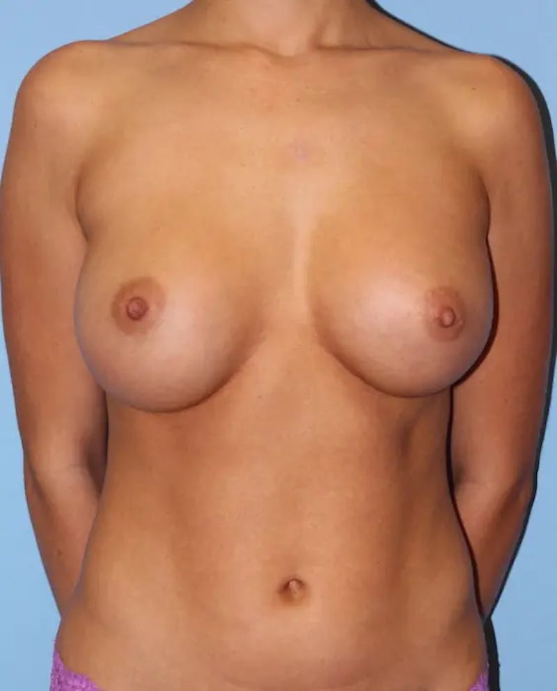 Breast Augmentation Before & After Gallery - Patient 289518 - Image 2