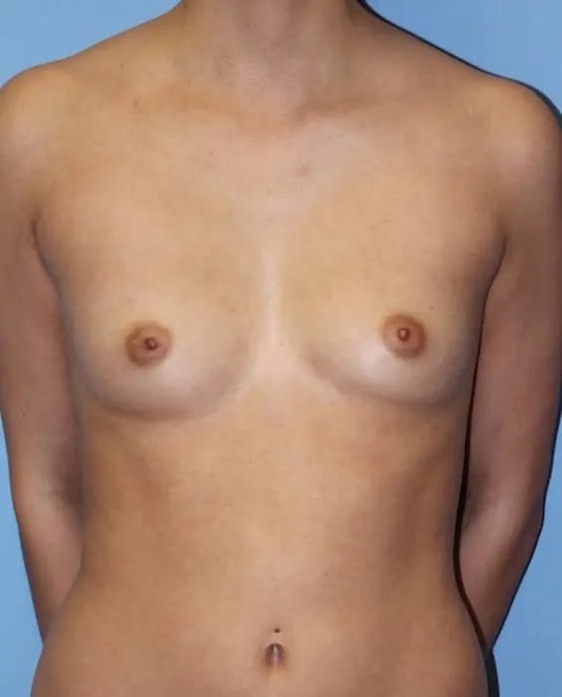 Breast Augmentation Before & After Gallery - Patient 227043 - Image 1