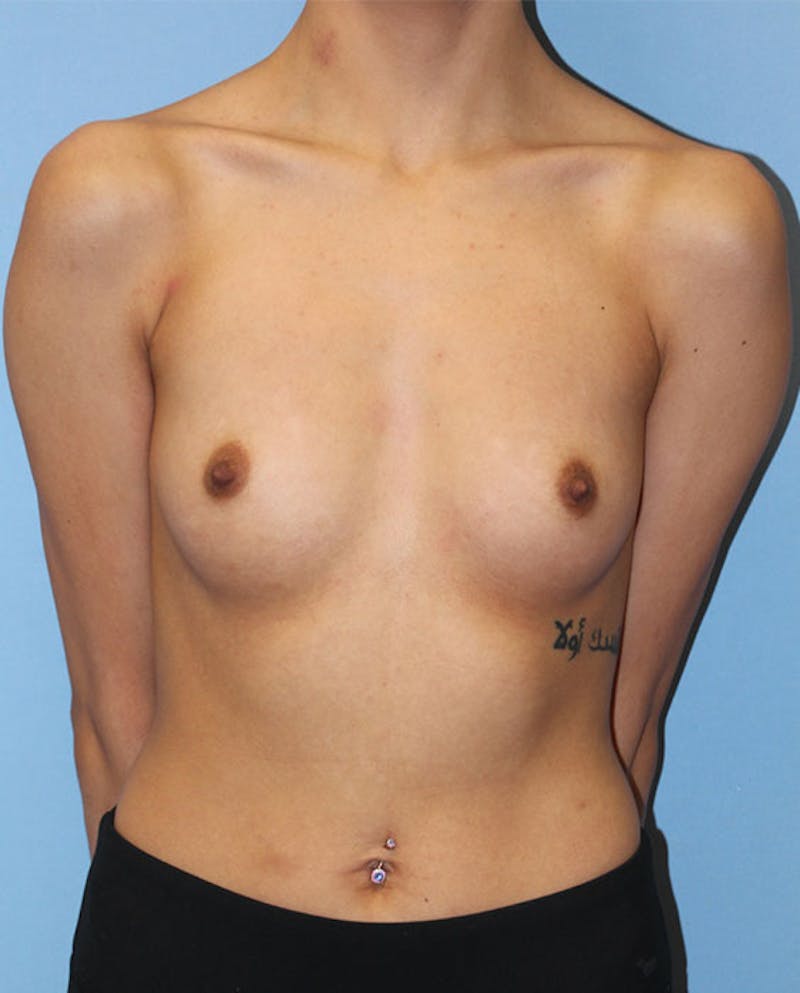 Breast Augmentation Before & After Gallery - Patient 281989 - Image 1