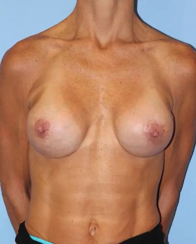 Breast Implant Revision Before & After Gallery - Patient 453095 - Image 2