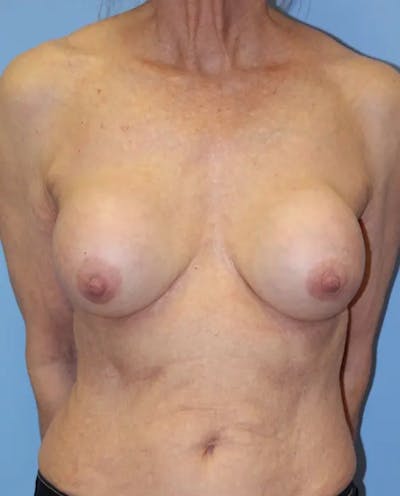 Breast Implant Revision Before & After Gallery - Patient 199943 - Image 1