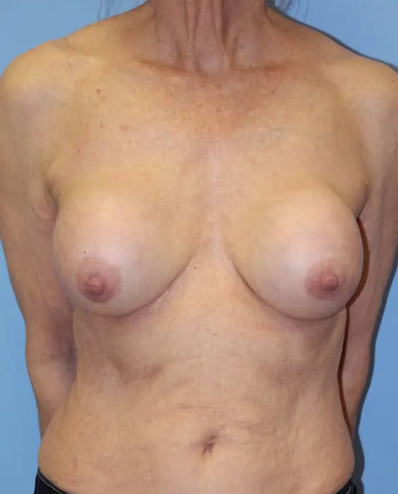 Breast Implant Revision Before & After Gallery - Patient 199943 - Image 1