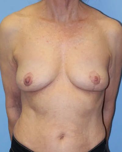 Breast Implant Revision Before & After Gallery - Patient 199943 - Image 2