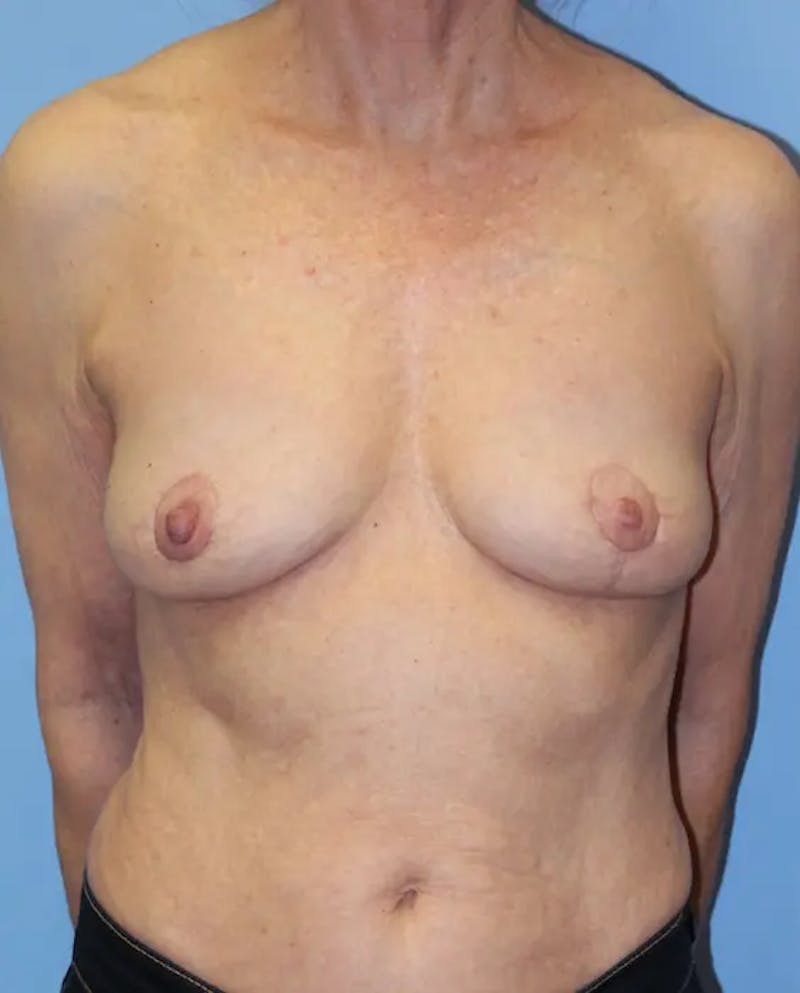 Breast Implant Revision Before & After Gallery - Patient 199943 - Image 2