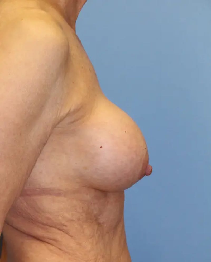 Breast Implant Revision Before & After Gallery - Patient 199943 - Image 5