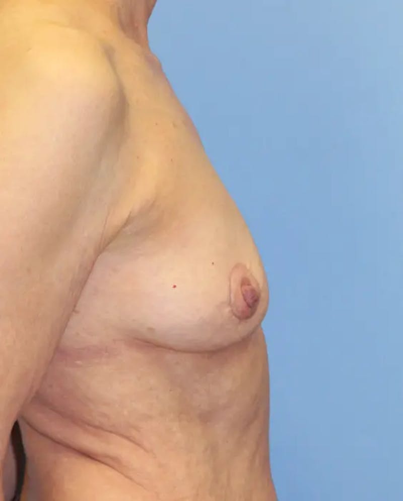 Breast Implant Revision Before & After Gallery - Patient 199943 - Image 6