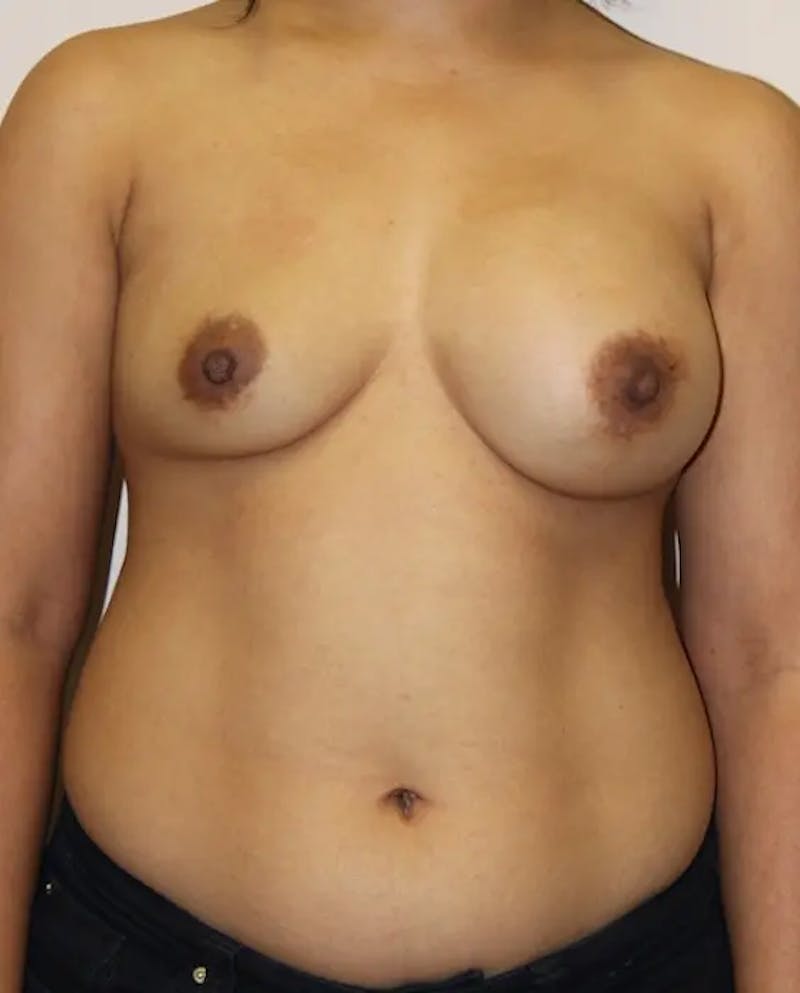 Breast Implant Revision Before & After Gallery - Patient 294181 - Image 1