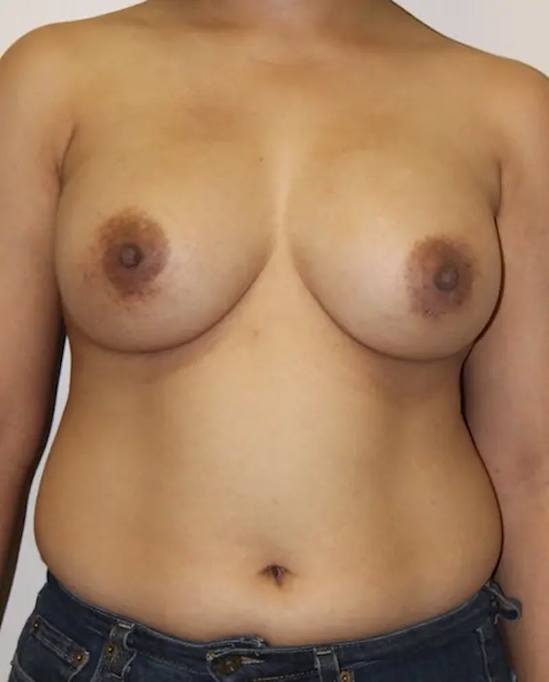 Breast Implant Revision Before & After Gallery - Patient 294181 - Image 2