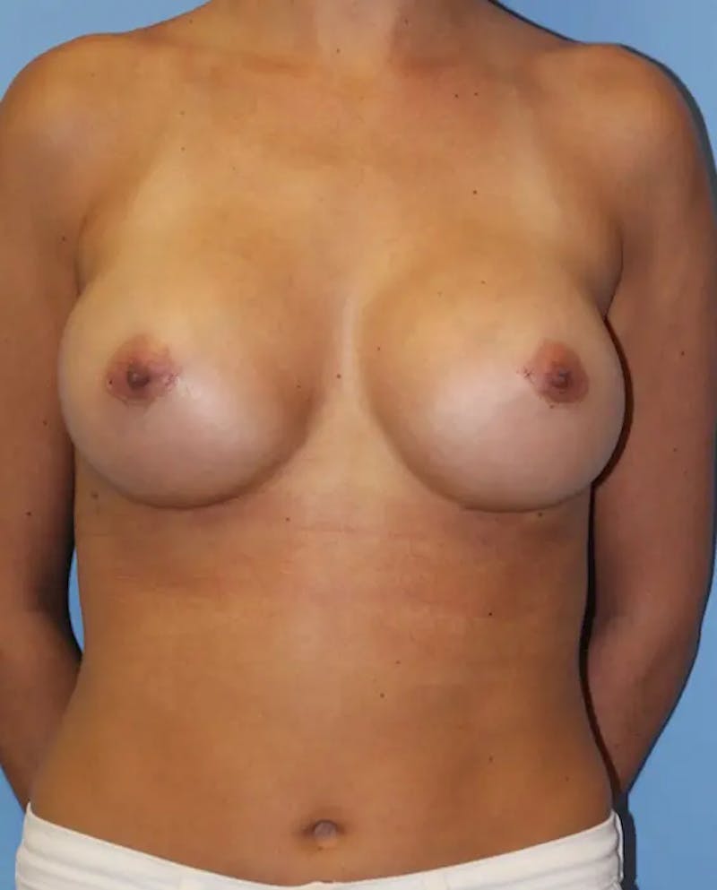 Breast Implant Revision Before & After Gallery - Patient 394731 - Image 2