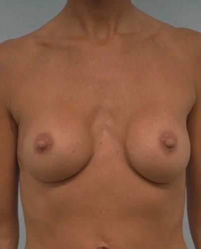 Breast Implant Revision Before & After Gallery - Patient 329116 - Image 1