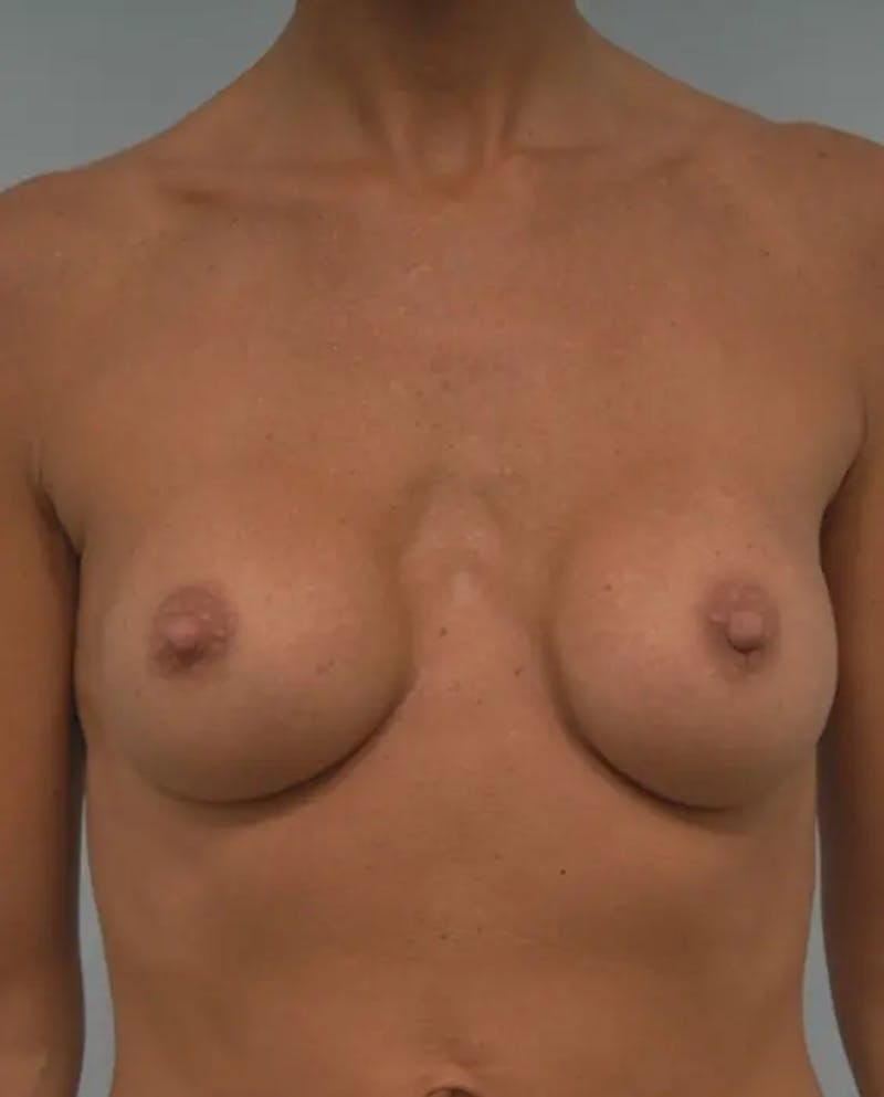 Breast Implant Revision Before & After Gallery - Patient 329116 - Image 1