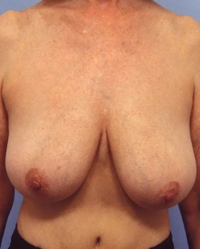 Breast Reduction Before & After Gallery - Patient 153767 - Image 1