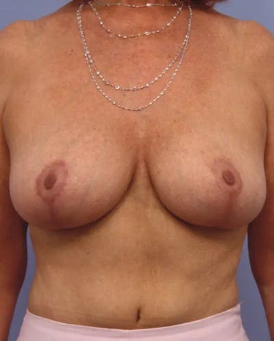 Breast Reduction Before & After Gallery - Patient 153767 - Image 2