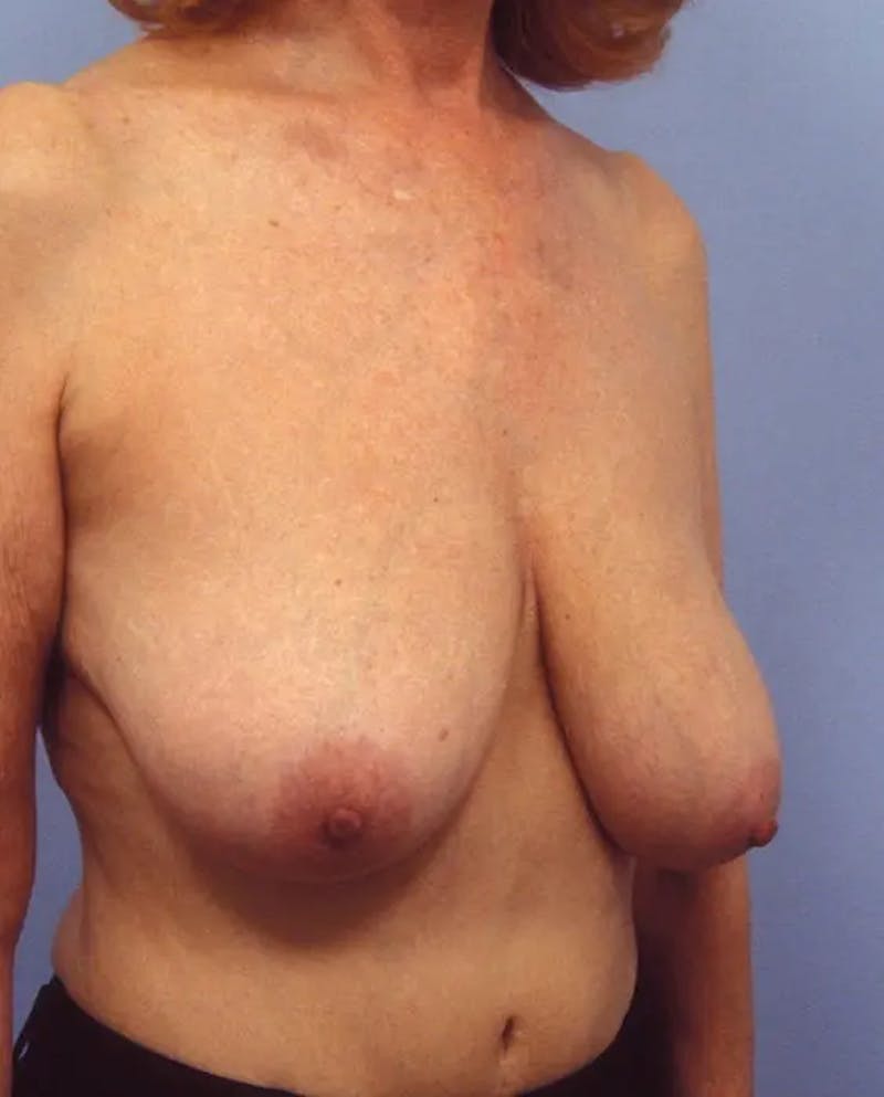 Breast Reduction Before & After Gallery - Patient 153767 - Image 3