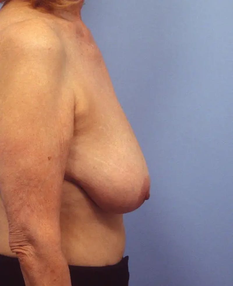 Breast Reduction Before & After Gallery - Patient 153767 - Image 5