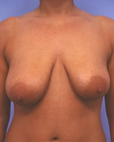 Breast Reduction Before & After Gallery - Patient 415508 - Image 1