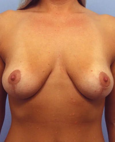 Breast Reduction Before & After Gallery - Patient 415508 - Image 2