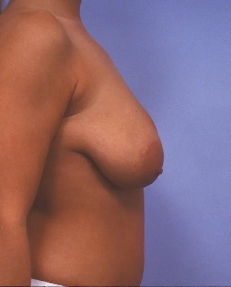 Breast Reduction Before & After Gallery - Patient 415508 - Image 5