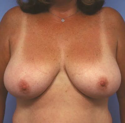 Breast Reduction Before & After Gallery - Patient 342548 - Image 1