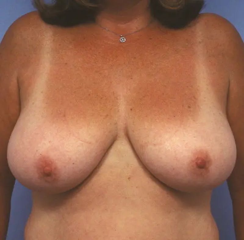 Breast Reduction Before & After Gallery - Patient 342548 - Image 1