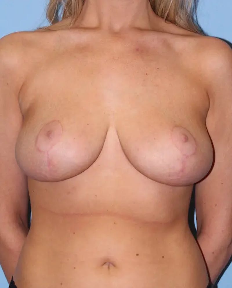 Breast Reduction Before & After Gallery - Patient 244494 - Image 2
