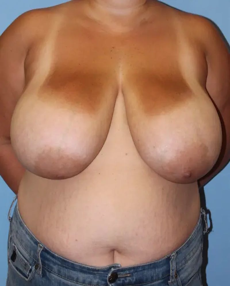 Breast Reduction Before & After Gallery - Patient 347061 - Image 1