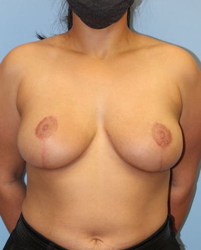 Breast Reduction Before & After Gallery - Patient 404931 - Image 2