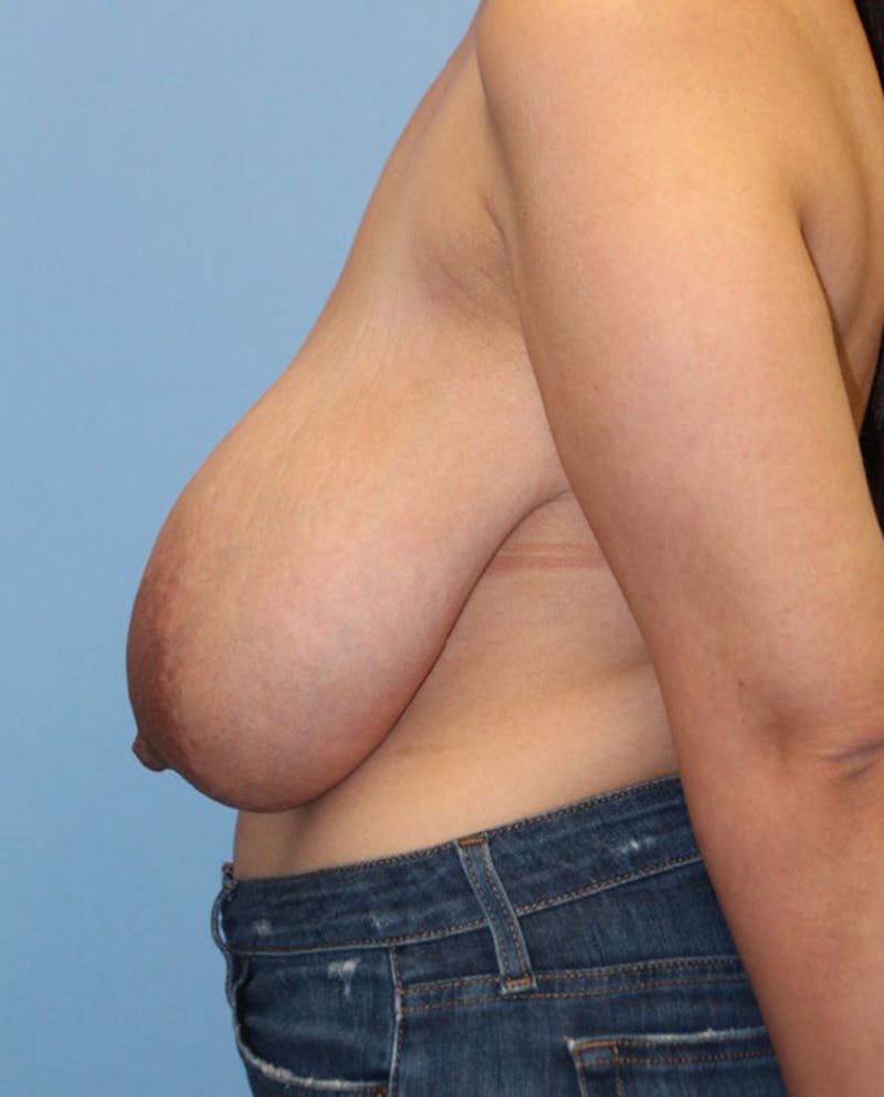 Breast Reduction Before & After Gallery - Patient 410121 - Image 5