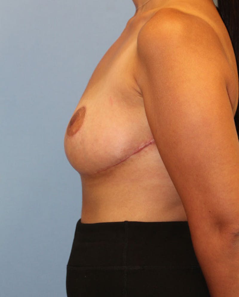 Breast Reduction Before & After Gallery - Patient 410121 - Image 6