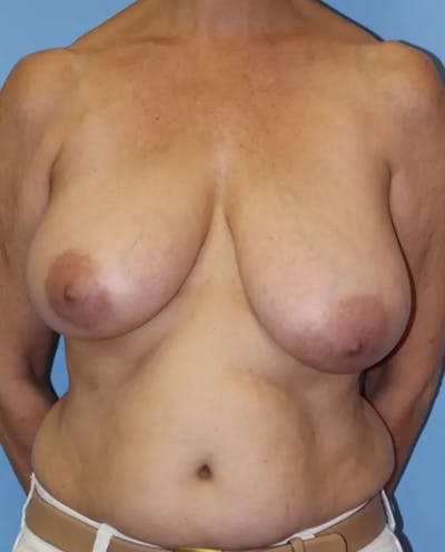 Breast Reduction Before & After Gallery - Patient 208193 - Image 1
