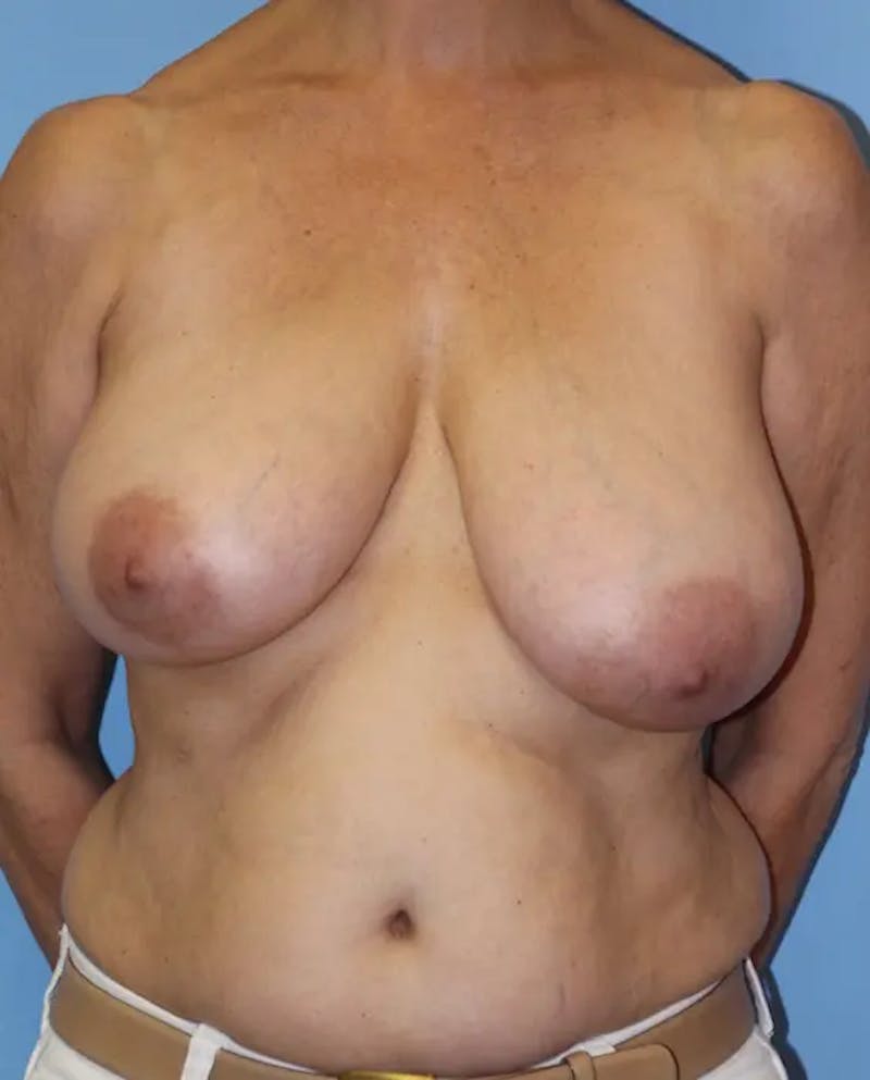 Breast Reduction Before & After Gallery - Patient 208193 - Image 1