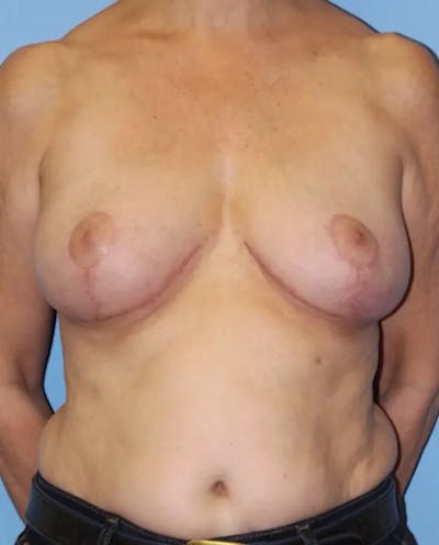 Breast Reduction Before & After Gallery - Patient 208193 - Image 2