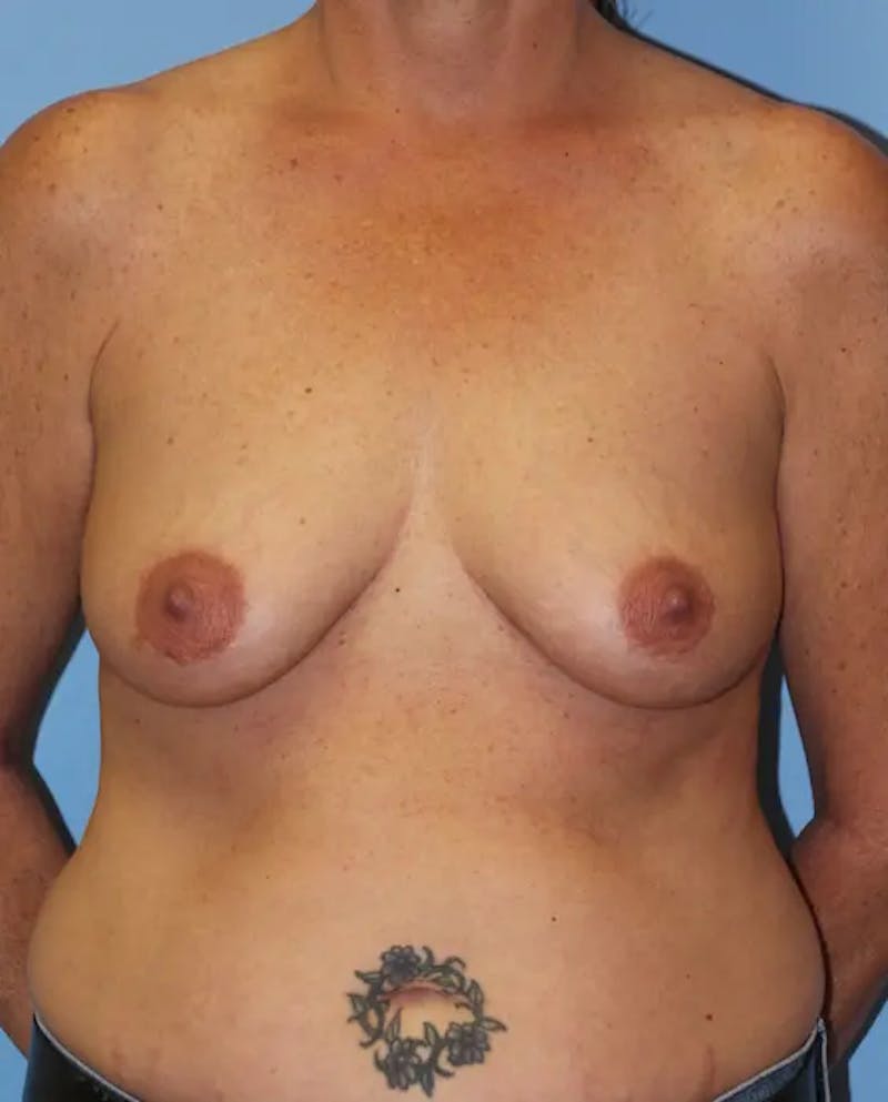 Breast Lift Before & After Gallery - Patient 201940 - Image 1