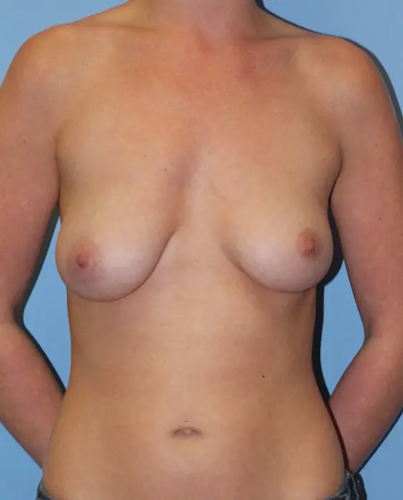 Breast Lift Before & After Gallery - Patient 298199 - Image 1