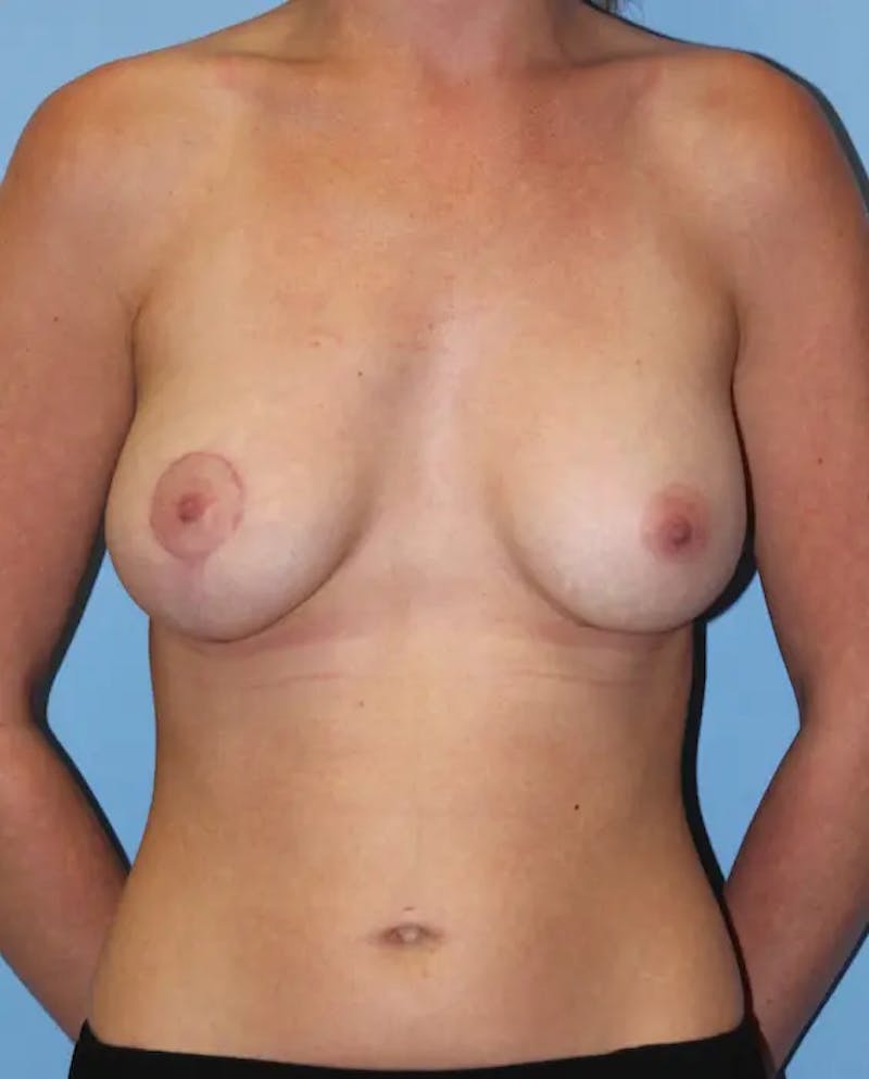 Breast Lift Before & After Gallery - Patient 298199 - Image 2