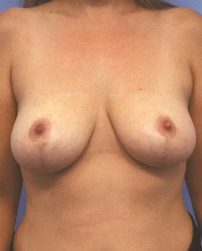 Breast Lift Before & After Gallery - Patient 393469 - Image 2
