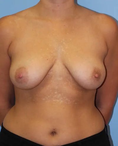 Breast Lift Before & After Gallery - Patient 374043 - Image 1