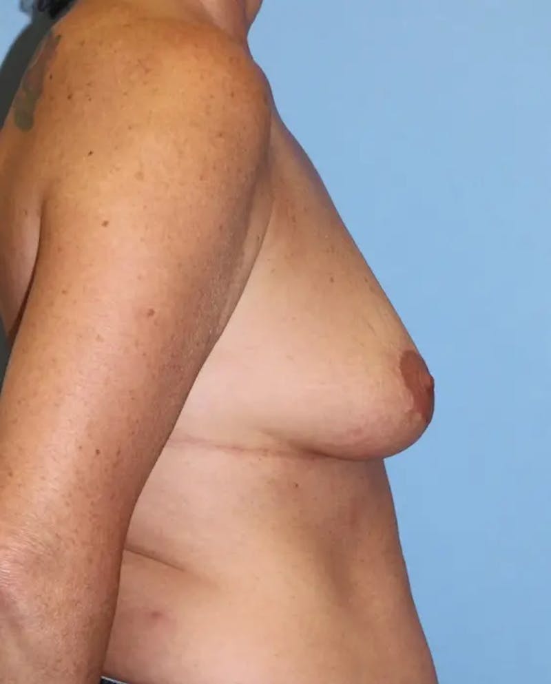 Breast Lift Before & After Gallery - Patient 213831 - Image 5