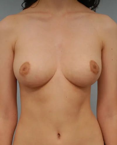 Breast Lift Before & After Gallery - Patient 394862 - Image 2