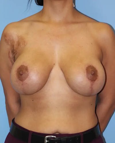 Breast Lift with Augmentation Before & After Gallery - Patient 406335 - Image 2